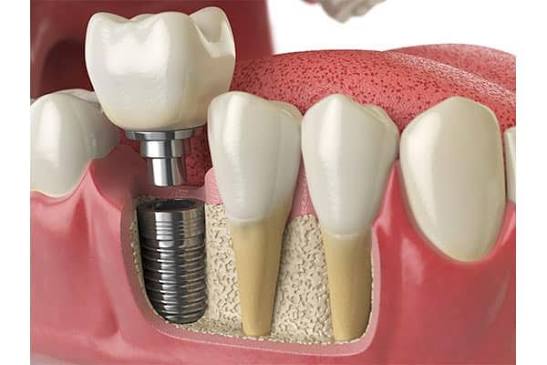 Dental Implants & Prosthodontics